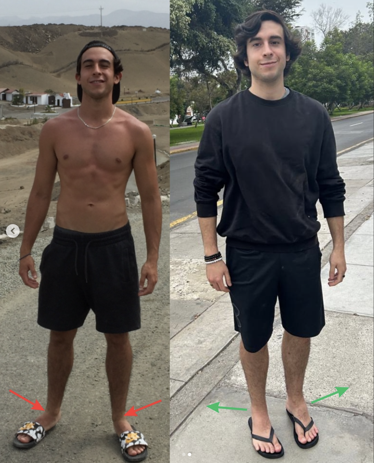 Comparativa antes y después de la alineación corporal al estar de pie
